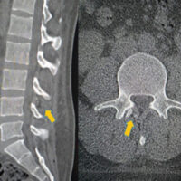 Figure 1: Sagittal and axial cuts of a computed tomography scan of the lumbar spine describing the retained epidural fragment at the L3-L4 level.