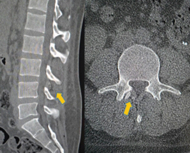 Figure 1: Sagittal and axial cuts of a computed tomography scan of the lumbar spine describing the retained epidural fragment at the L3-L4 level.