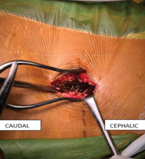 Figure 2: Intraoperative exposure of epidural catheter segment.