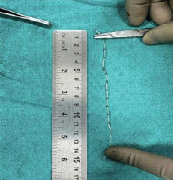 Figure 3: Retrieved epidural catheter segment following complete removal.
