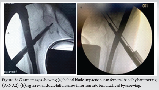 Comparative Study between Proximal Femoral Nail Anti Rotation and ...