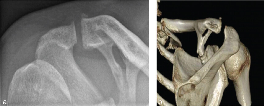 Figure 2: (a and b) Anterior-posterior view X-ray of the right shoulder and posterior view of 3D reconstruction computed tomography scan of case 1.