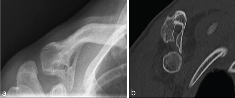 Figure 3: (a and b) Anterior-posterior view X-ray of the right shoulder and anterior-posterior of computed tomography scan screenshot through coracoclavicular ossification of case 2.