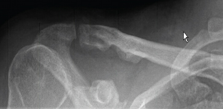 Figure 4: Post-operative anterior-posterior view X-ray of the right shoulder of case 1.