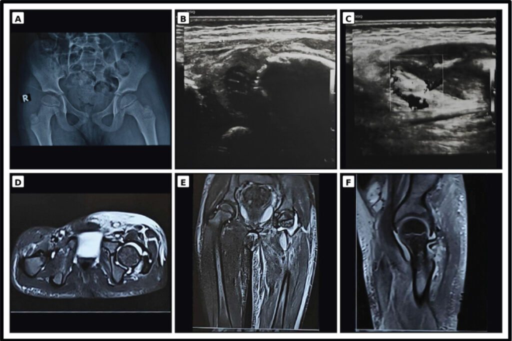 Figure 2: Representative multimodal imaging of a partially treated child with low admission inflammatory markers and operatively confirmed septic arthritis. (a) Anteroposterior pelvic radiograph shows maintained hip alignment without a definite acute osseous abnormality. (b and c) Grayscale and Doppler HRUSG demonstrate capsular distension, complex joint effusion and synovial hyperemia in the symptomatic hip. (d, e, f) Axial, coronal, and sagittal fluid-sensitive MR images confirm hip-joint effusion with synovial and periarticular inflammatory change; no adjacent osseous focus is evident in the displayed sections. Frank intra-articular pus was subsequently documented at open arthrotomy. HRUSG: High-resolution ultrasonography, MRI: Magnetic resonance imaging.