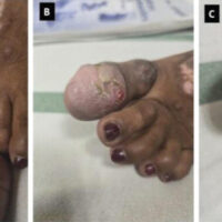 Figure 1: Clinical photographs of the affected great toe showing a fusiform, globular enlargement of the distal great toe with stretched, shiny skin, areas of hyperkeratosis and superficial ulceration, and distortion of the nail plate, indicating a locally aggressive lesion with cutaneous compromise.