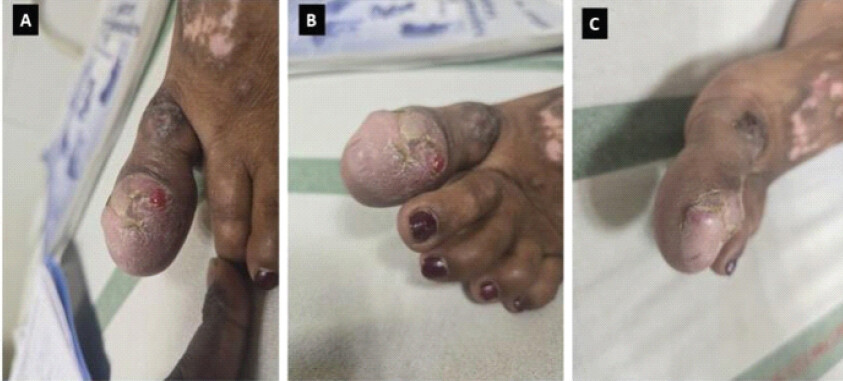 Figure 1: Clinical photographs of the affected great toe showing a fusiform, globular enlargement of the distal great toe with stretched, shiny skin, areas of hyperkeratosis and superficial ulceration, and distortion of the nail plate, indicating a locally aggressive lesion with cutaneous compromise.