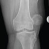 The Irreducible Patella in the Elderly Patient: A Case Report