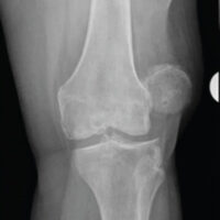Figure 1: Oblique x-ray of left knee with laterally displaced patellar dislocation.