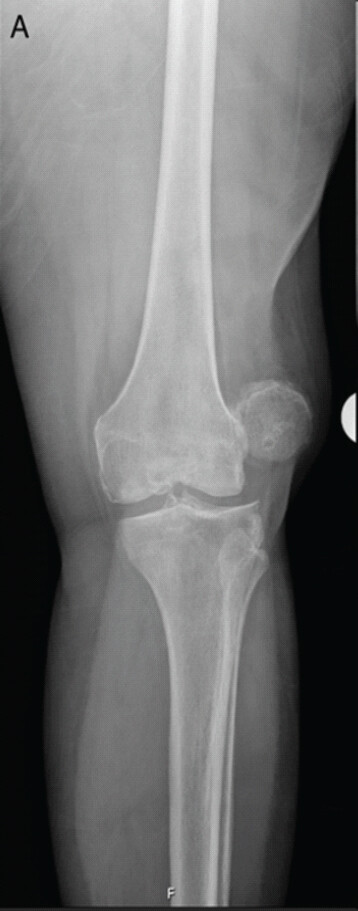 Figure 1: Oblique x-ray of left knee with laterally displaced patellar dislocation.