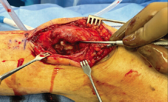Figure 10: Femoral impaction appreciated after reduction of patella dislocation.