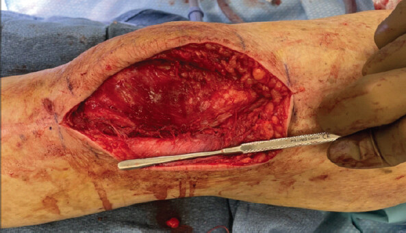 Figure 11: Closure of the retinaculum holding reduction.
