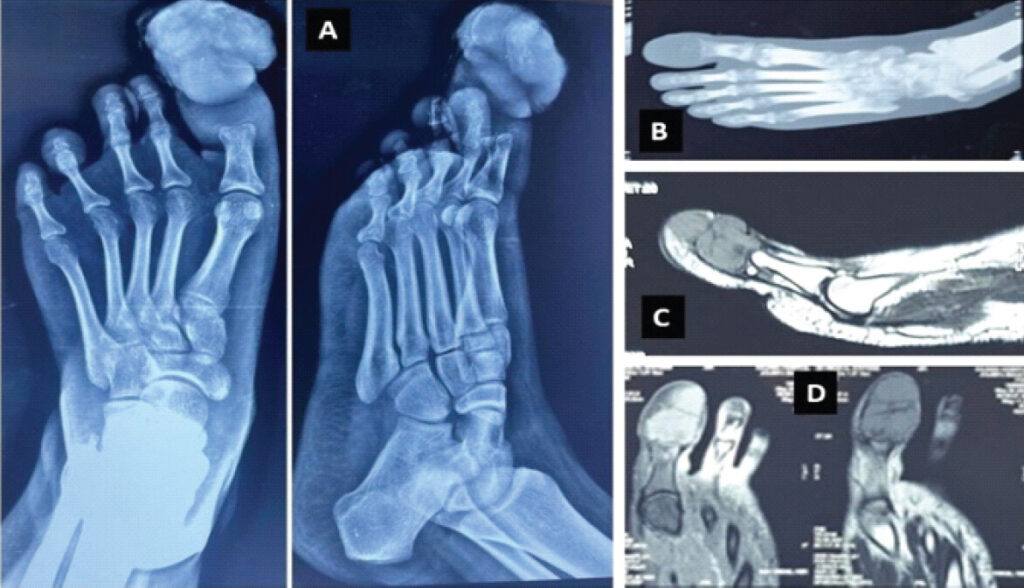 Figure 2: Anteroposterior and lateral radiograph of the foot demonstrating an expansile osteolytic lesion involving the distal phalanx of the great toe, with cortical thinning and destruction, without matrix calcification or periosteal reaction (a); Computed tomography scan of the foot showing ballooning expansion of the distal phalanx, confirming the aggressive lytic nature of the lesion and loss of normal bony architecture (b); Sagittal MRI of the great toe demonstrating a lobulated lesion involving the distal phalanx, with extension up to the subungual region and soft tissue involvement, consistent with a locally aggressive bone tumor (c); Coronal MRI showing replacement of the distal phalanx by tumor tissue with adjacent soft tissue extension, while the proximal phalanx and metatarsophalangeal joint appear preserved (d). MRI: Magnetic resonance imaging.