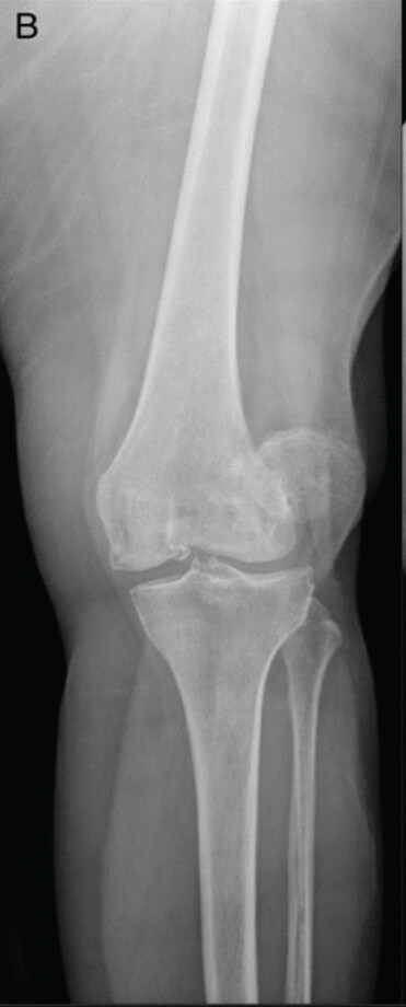 Figure 2: Anteroposterior x-ray of the left knee with laterally displaced patellar dislocation.