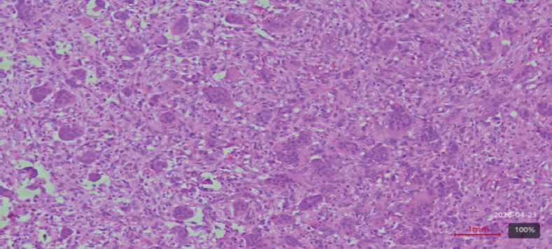 Figure 3: Histopathological section (H and E stain) showing features of a giant cell tumor of bone. Numerous uniformly distributed multinucleated osteoclast-like giant cells are seen dispersed within a background of mononuclear stromal cells. The stromal cells are oval to spindle-shaped with bland nuclei, representing the neoplastic component. Areas of hemorrhage and focal stromal cellularity are also evident (original magnification ×100).