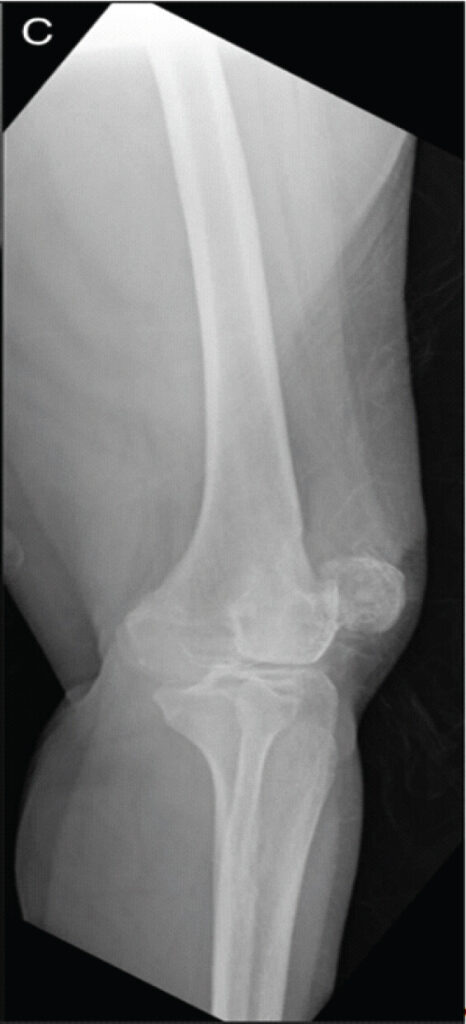 Figure3: Attempted lateral x-ray of left knee for lateral patella view, demonstrating patellar dislocation.