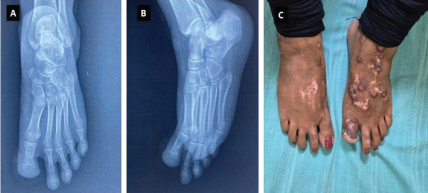 Figure 4: (a and b) Post-operative anteroposterior and lateral radiographs after distal phalanx resection; (c) A clinical picture of the bilateral foot after resection of the left toe distal phalanx.