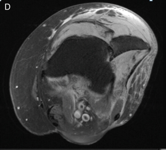 Figure 4: Axial cut of magnetic resonance imaging of the left knee with lateral patella dislocation with the medial border of the patella impacted on the lateral femoral condyle. Osteophytes also noted between the patella and femoral condyle.