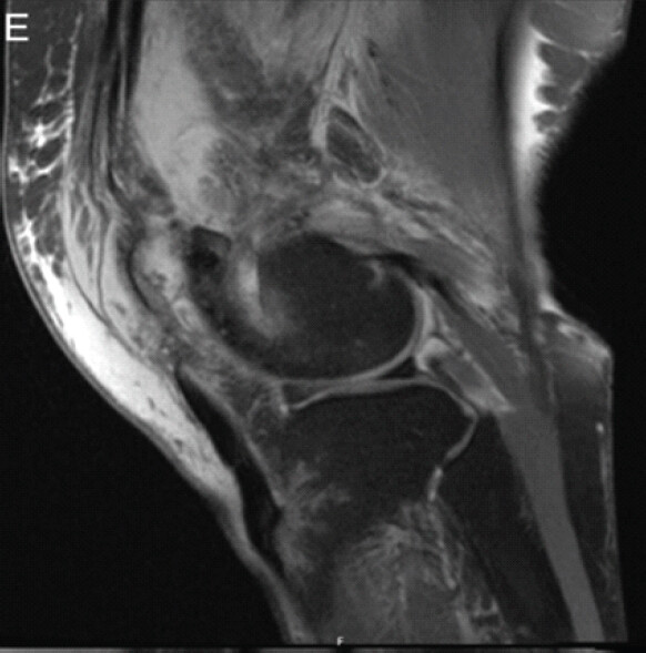 Figure 5: Sagittal cut of magnetic resonance imaging of the left knee with lateral patella dislocation. Lateral view of tibia and femur with enface view of dislocated patella.