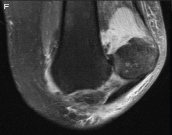 Figure 6: Coronal cut of magnetic resonance imaging of the left knee with lateral patella dislocation. The medial border of the patella is along the lateral femoral epicondyle.