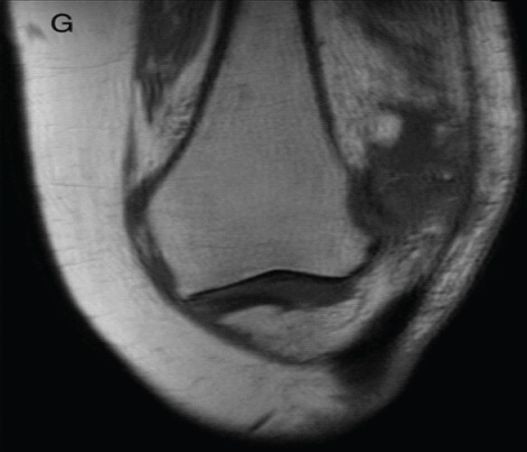 Figure 7: Coronal cut of magnetic resonance imaging of the left knee with lateral patella dislocation, with notable lateral femoral condyle impaction injury.