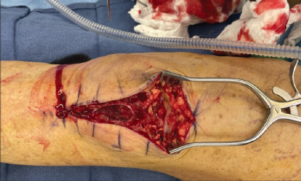 Figure 8: Traumatic soft-tissue disruption noted while dissecting down to the injury. Retinaculum tear is seen in the lateral parapatellar area.