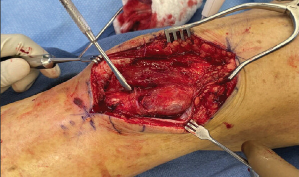 Figure 9: Laterally dislocated patella noted. It is lodged on the femoral condyle with button-holing through soft tissue.