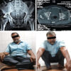 Functional Outcomes of Surgical Management of Posterior Wall Acetabular Fractures: A Prospective Study