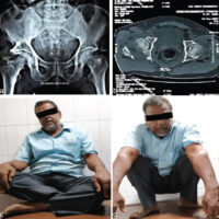 Figure 1: (a) Radiograph of pelvis AP view showing right side posterior acetabular wall fracture. (b) Computed tomography scan axial cut showing posterior acetabular wall fracture in the right side. (c) Functional outcome after 18 months of surgery. Patient able to sit cross-legged. (d) Functional outcome after 18 months of surgery. Patient able to sit Squad.