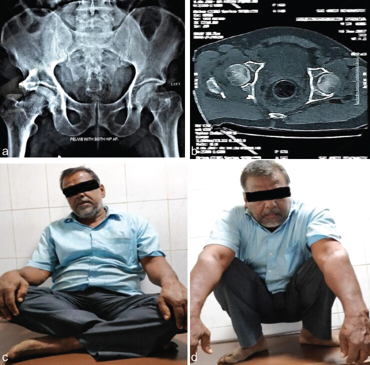 Figure 1: (a) Radiograph of pelvis AP view showing right side posterior acetabular wall fracture. (b) Computed tomography scan axial cut showing posterior acetabular wall fracture in the right side. (c) Functional outcome after 18 months of surgery. Patient able to sit cross-legged. (d) Functional outcome after 18 months of surgery. Patient able to sit Squad.