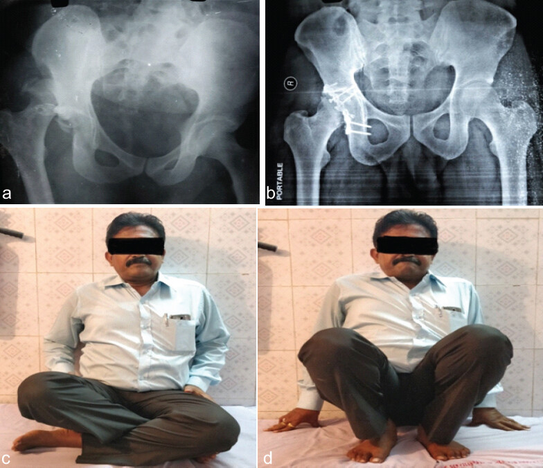 Figure 2: (a) Radiograph of pelvis AP view showing right side posterior acetabular wall fracture with hip dislocation. (b) Immediate post-operative radiograph of pelvis AP view after open reduction and internal fixation of posterior acetabular wall. (c) Functional outcome after 18 months of surgery. Patient able to sit cross-legged. (d) Functional outcome after 18 months of surgery. Patient able to squat.