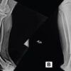 Compression of the Diseased Segment and Regeneration through Healthy Bone for Salvage of Infected Recurrent Congenital Pseudarthrosis of the Tibia in an Adult: A Case Report
