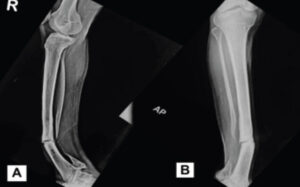 Figure 1: Pre-operative radiographic presentation. (a) Anteroposterior radiograph demonstrating tibial pseudarthrosis with obliteration of the medullary canal. (b) Lateral radiograph demonstrating a flexion deformity at the pseudarthrosis site.