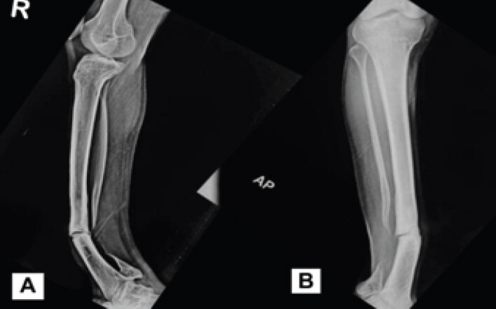 Figure 1: Pre-operative radiographic presentation. (a) Anteroposterior radiograph demonstrating tibial pseudarthrosis with obliteration of the medullary canal. (b) Lateral radiograph demonstrating a flexion deformity at the pseudarthrosis site.