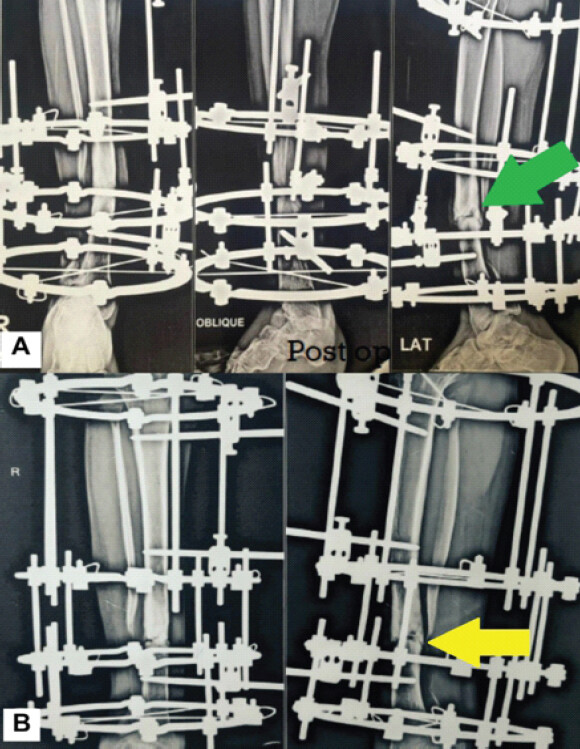 Figure 2: Initial Ilizarov compression. (a) Immediate post-operative radiograph following application of the Ilizarov circular external fixator, with the green arrow indicating axial compression across the pseudarthrosis. (b) Radiograph obtained at 4-month follow-up demonstrating absence of progressive osseous consolidation across the pseudarthrosis (yellow arrow).