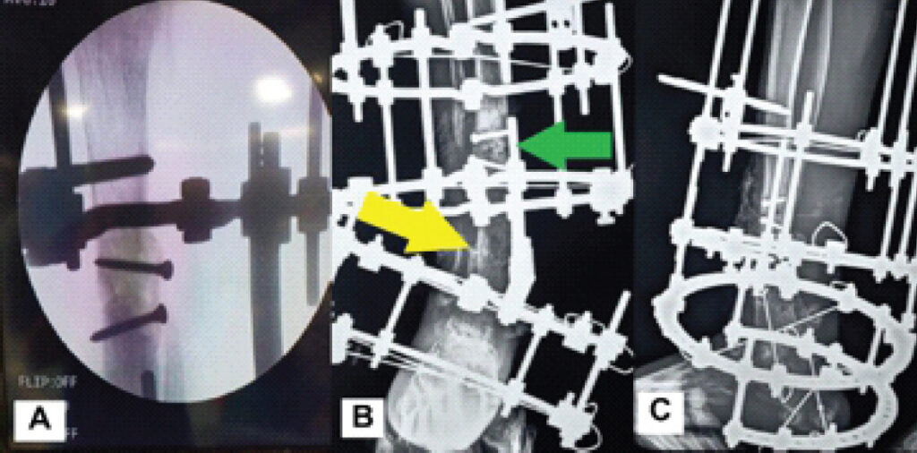 Figure 3: Biological augmentation and correction of ankle valgus. (a) Intraoperative fluoroscopic image demonstrating placement of a tricortical iliac crest onlay graft across the pseudarthrosis and fixation with cortical screws. (b) Immediate post-operative anteroposterior radiograph demonstrating the grafted pseudarthrosis site (green arrow) and supramalleolar osteotomy (yellow arrow). (c) Immediate post-operative lateral radiograph demonstrating the reconstructed tibial segment.
