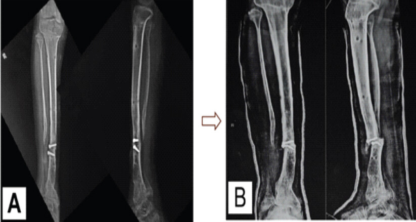 Figure 4: Initial union and subsequent graft-site fracture. (a) Follow-up anteroposterior and lateral radiographs obtained after removal of the Ilizarov fixator, demonstrating radiographic union across the reconstructed pseudarthrosis. (b) Subsequent anteroposterior and lateral radiographs demonstrating fracture through the reconstructed graft site.