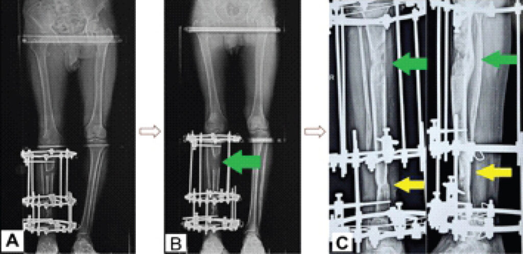 Figure 5: Definitive salvage reconstruction and progression of distraction osteogenesis. (a) Scannogram obtained during the early distraction phase demonstrating 2 cm of proximal tibial distraction. (b) Scannogram following completion of limb lengthening, demonstrating 7 cm of distraction with regenerate formation at the proximal tibial corticotomy site (green arrow). (c) Anteroposterior and lateral radiographs obtained 10 months after the definitive salvage procedure, demonstrating consolidation of the proximal tibial regenerate (green arrow) and osseous union across the compressed distal pseudarthrosis (yellow arrow).