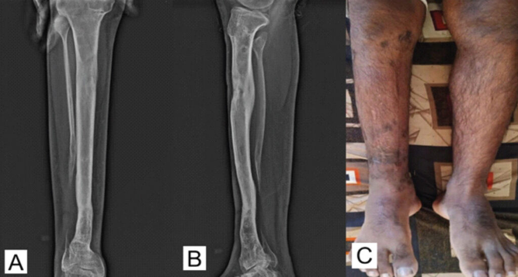 Figure 6: Final radiographic and clinical outcome at 24-month follow-up. (a and b) Anteroposterior and lateral radiographs of the right tibia demonstrating maintained osseous union at the distal pseudarthrosis, complete consolidation and remodeling of the proximal tibial regenerate, and preservation of limb alignment. (c) Final clinical photograph demonstrating restored limb-length equality and satisfactory coronal alignment of the right lower extremity.