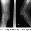 Arthroscopic ACL Tibial Spine Avulsion Fixation Using Suture Pull-Through Double-Tunnel Technique