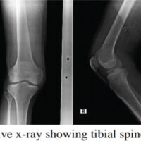 Figure 1: Pre-operative radiographs showing the tibial spine avulsion fracture.