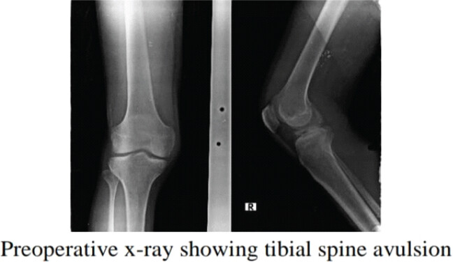Figure 1: Pre-operative radiographs showing the tibial spine avulsion fracture.
