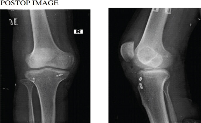 Figure 2: Post-operative radiographs demonstrating reduction and the tibial tunnel fixation construct.