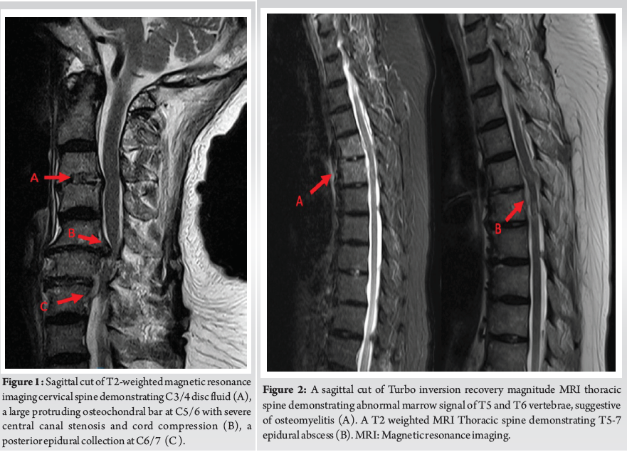 Multiple Spinal Epidural Abscesses with Concomitant Multifocal Systemic ...