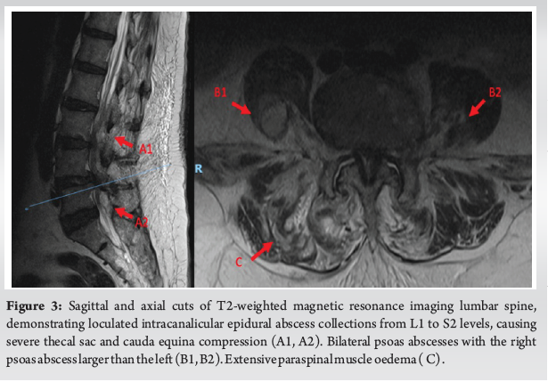 Multiple Spinal Epidural Abscesses with Concomitant Multifocal Systemic ...