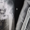 Concomitant Neck of Femur and Greater Trochanter Fracture in a Young Adult – A Case Report