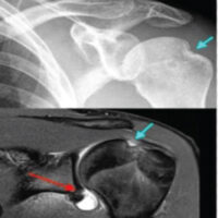 Figure 1: Hill-Sach’s lesion and Bankart’s lesion on radiograph and magnetic resonance imaging.