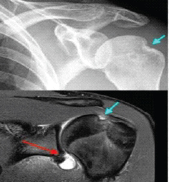 Figure 1: Hill-Sach’s lesion and Bankart’s lesion on radiograph and magnetic resonance imaging.