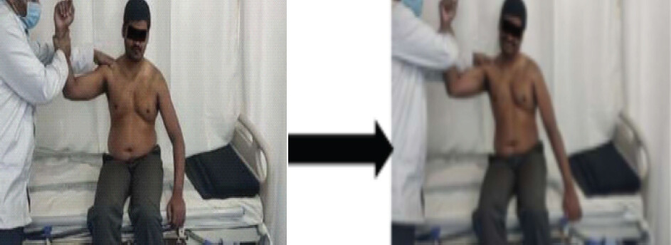 Figure 2: Demonstration of anterior apprehension test being positive.