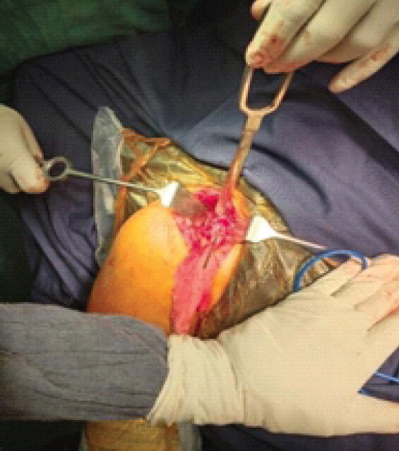 Figure 3: Conjoint tendon identified and coracoid process osteotomized.